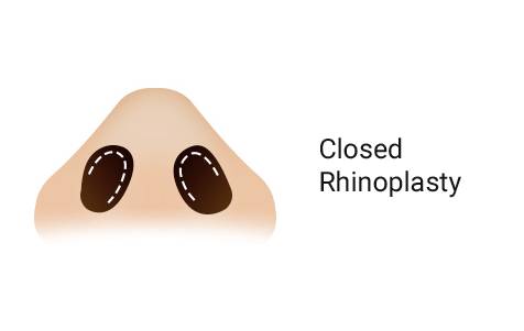 Closed Rhinoplasty