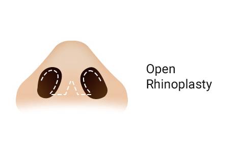 Open Rhinoplasty