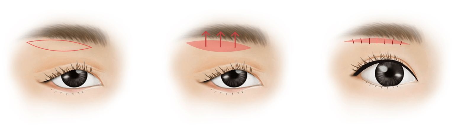 Upper Eyelid Fat Pad Removal (Enhance Double Eyelid Appearance