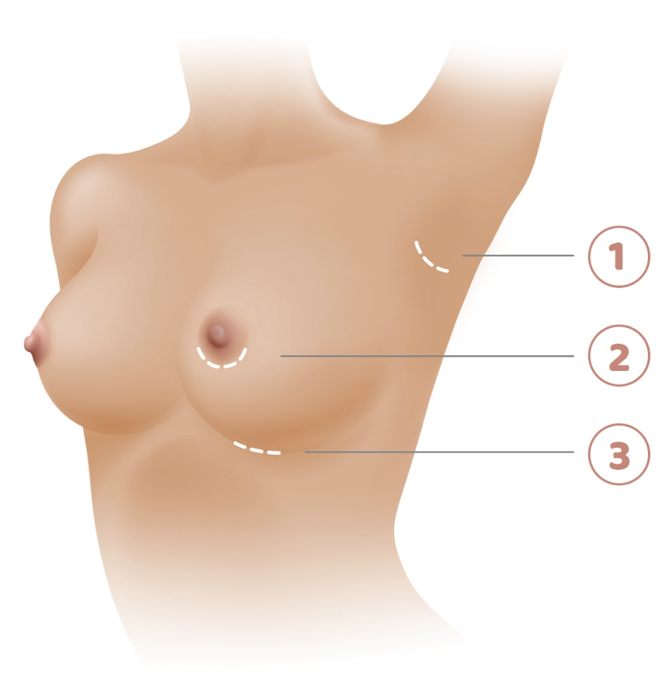 Breast Incisions